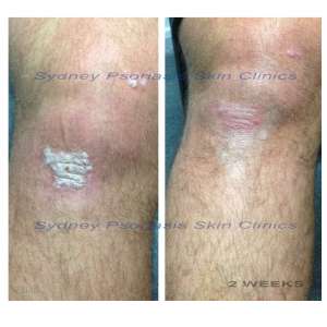 Chronic Plaque Psoriasis (Psoriasis Vulgaris)