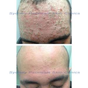 Chronic Plaque Psoriasis (Psoriasis Vulgaris)
