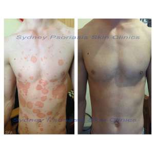 Chronic Plaque Psoriasis (Psoriasis Vulgaris)